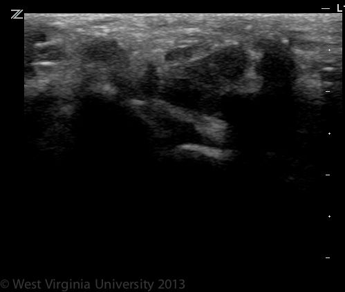 Median Nerve in Carpal Tunnel