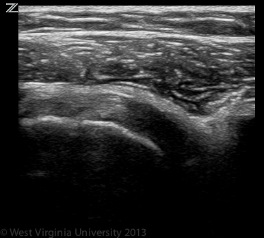 Long Axis Subscapularis Tendon coursing over the lesser trochanter.