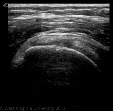 Long Axis Supraspinatus Tendon