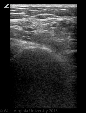Long Axis Infraspinatus Tendon